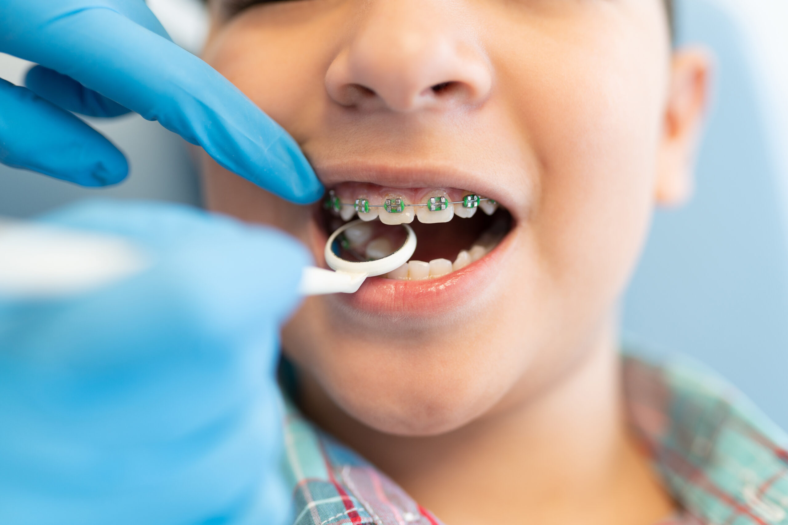 Closeup of orthodontist examining boy wearing braces with dental mirror